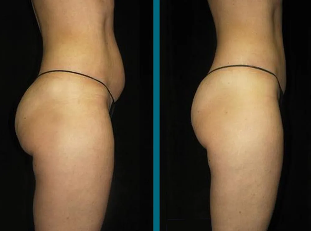 Before and after Contour Light body-contouring result 5