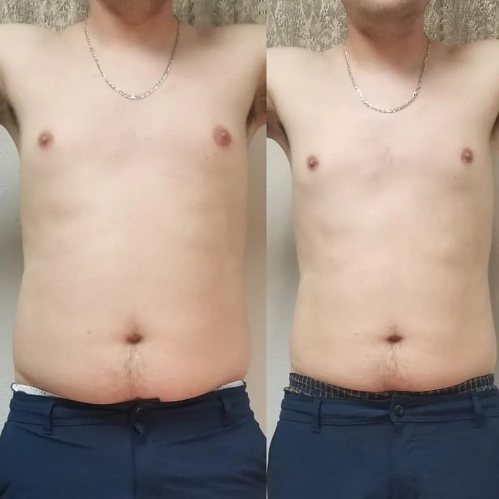 Before and after Contour Light body-contouring result 2