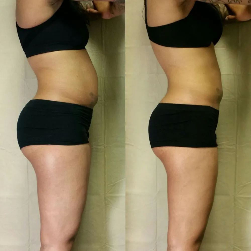 Before and after Contour Light body-contouring result 4