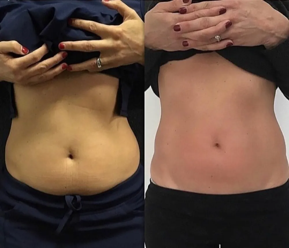 Before and after Contour Light body-contouring result 3